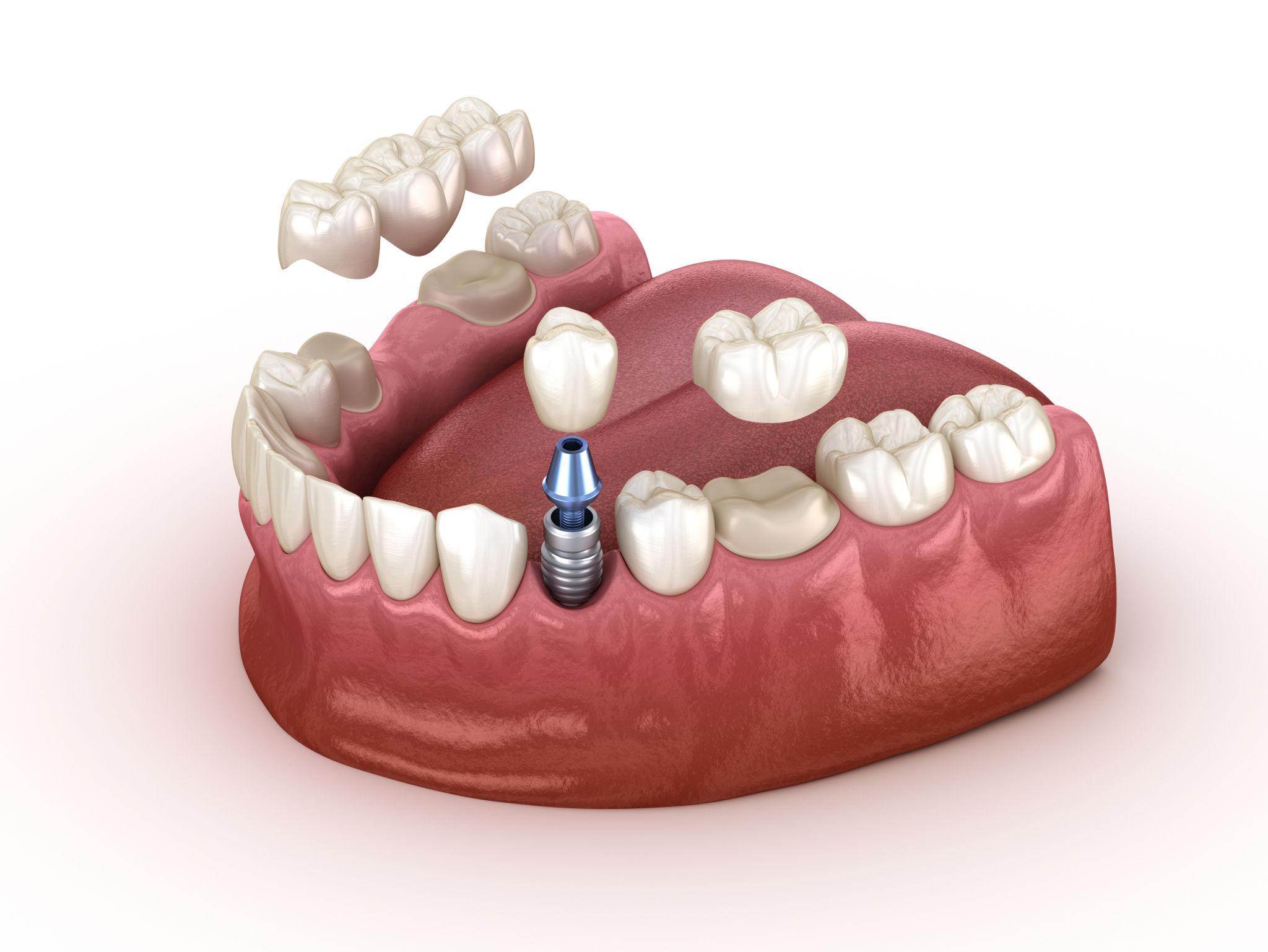 Full Mouth Rehabilitation: Complete Smile Makeover & Functional Smile Restoration Guide